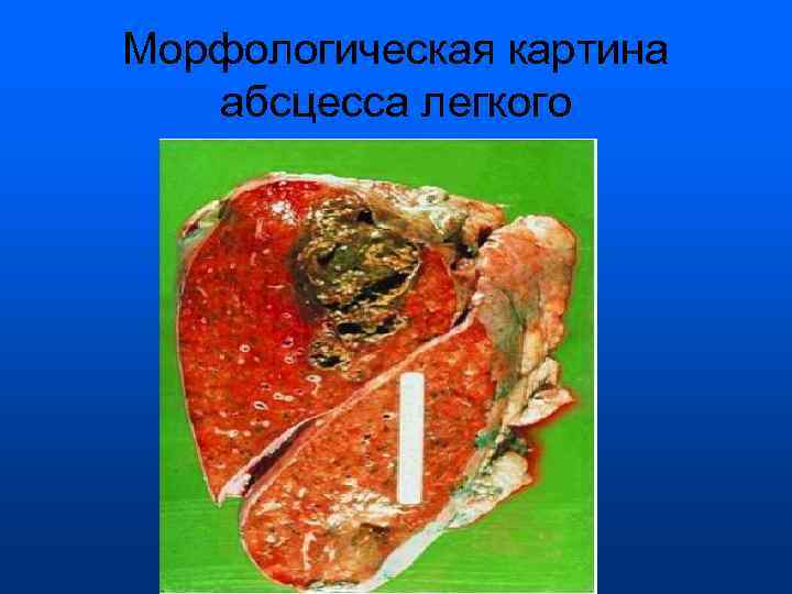 Морфологическая картина абсцесса легкого 