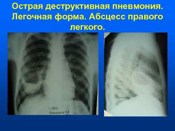 Острая деструктивная пневмония. Легочная форма. Абсцесс правого   легкого. 