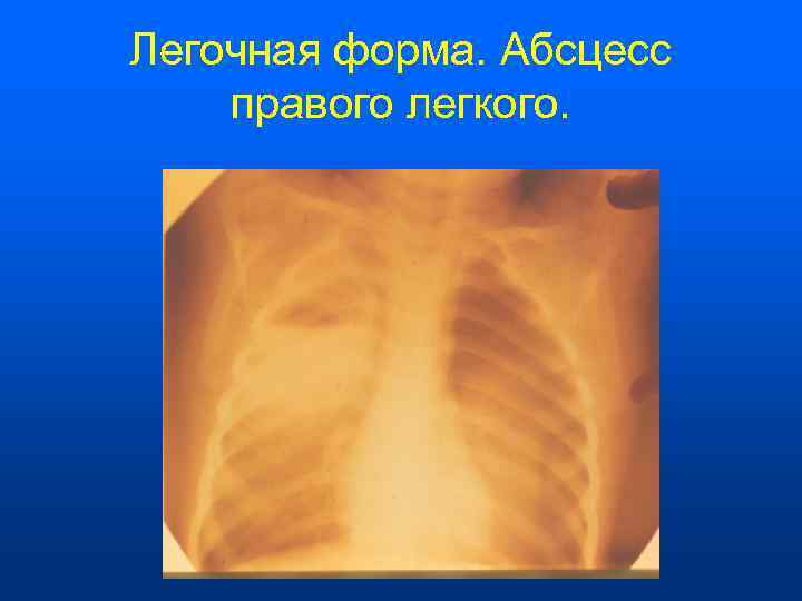 Легочная форма. Абсцесс правого легкого. 
