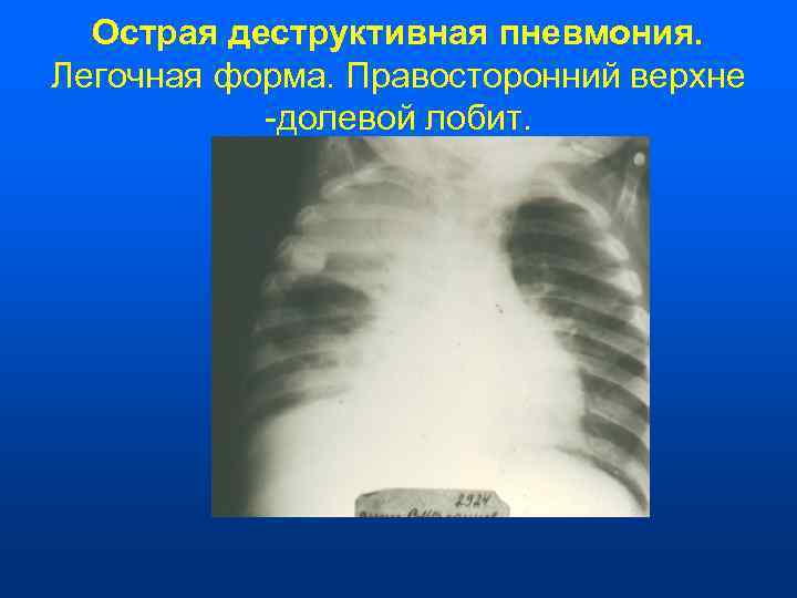  Острая деструктивная пневмония. Легочная форма. Правосторонний верхне  -долевой лобит. 