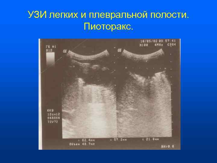 УЗИ легких и плевральной полости.    Пиоторакс. 