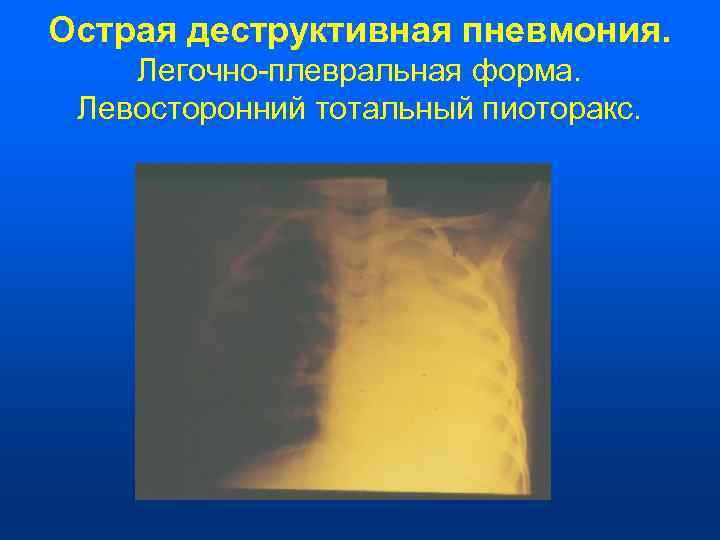 Острая деструктивная пневмония. Легочно-плевральная форма.  Левосторонний тотальный пиоторакс. 