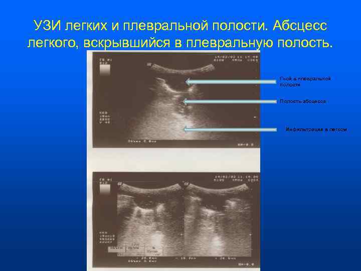  УЗИ легких и плевральной полости. Абсцесс легкого, вскрывшийся в плевральную полость.  