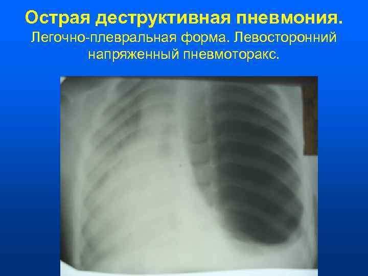 Острая деструктивная пневмония. Легочно-плевральная форма. Левосторонний   напряженный пневмоторакс. 