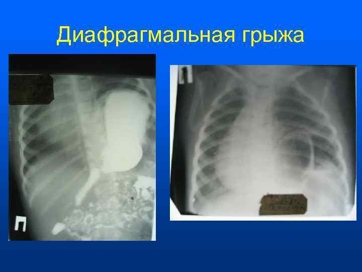 Диафрагмальная грыжа 
