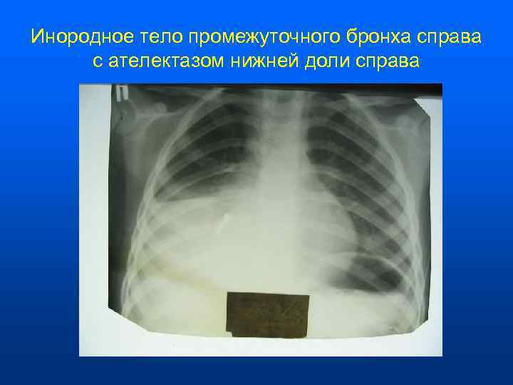 Инородное тело промежуточного бронха справа  с ателектазом нижней доли справа 