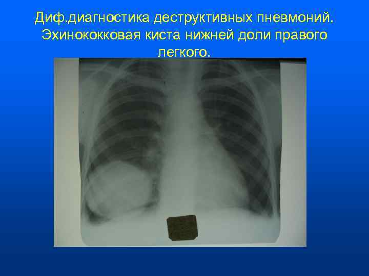 Диф. диагностика деструктивных пневмоний.  Эхинококковая киста нижней доли правого    легкого.