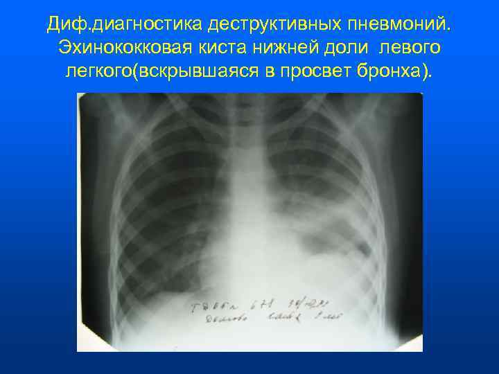 Диф. диагностика деструктивных пневмоний.  Эхинококковая киста нижней доли левого  легкого(вскрывшаяся в просвет