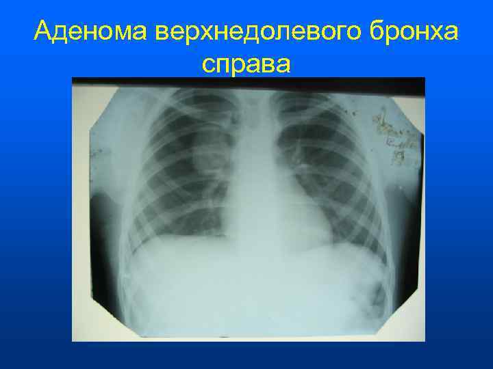 Аденома верхнедолевого бронха   справа 