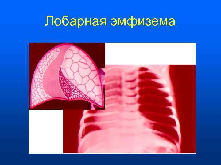 Лобарная эмфизема 