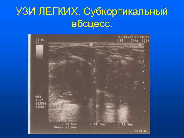 УЗИ ЛЕГКИХ. Субкортикальный  абсцесс. 