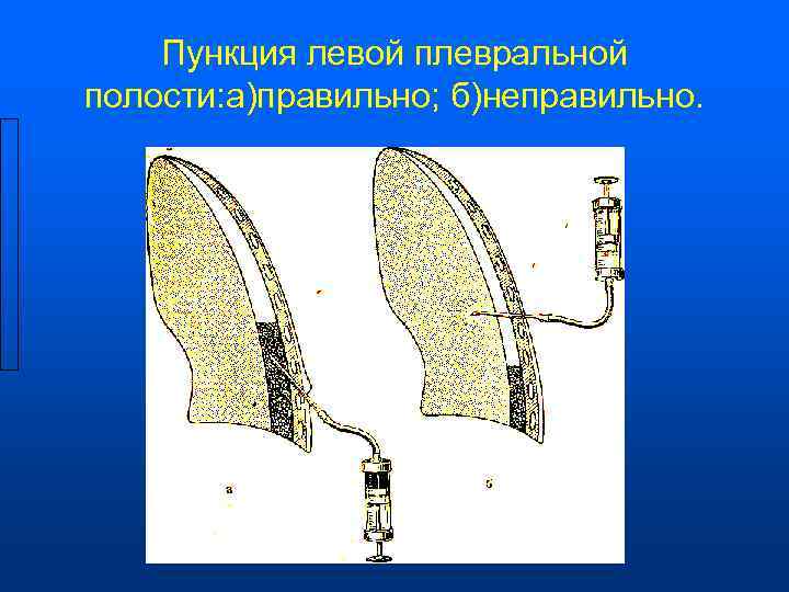  Пункция левой плевральной полости: а)правильно; б)неправильно. 
