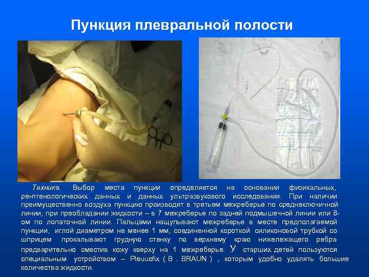    Пункция плевральной полости  Техника. Выбор места пункции определяется на основании
