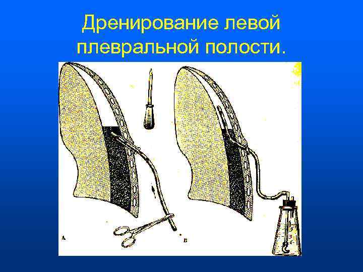  Дренирование левой плевральной полости. 