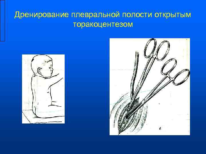 Дренирование плевральной полости открытым    торакоцентезом 