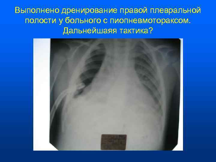 Выполнено дренирование правой плевральной  полости у больного с пиопневмотораксом.   Дальнейшаяя тактика?