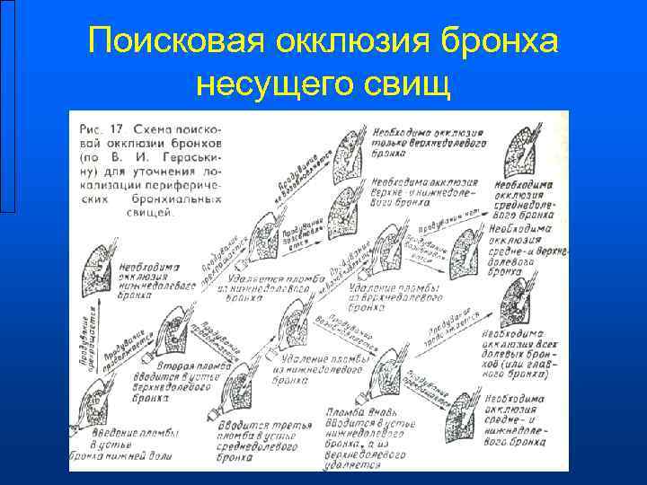 Поисковая окклюзия бронха  несущего свищ 