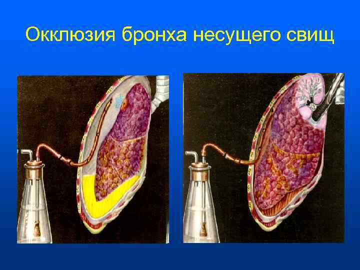 Окклюзия бронха несущего свищ 