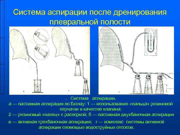  Система аспирации после дренирования  плевральной полости     . Система