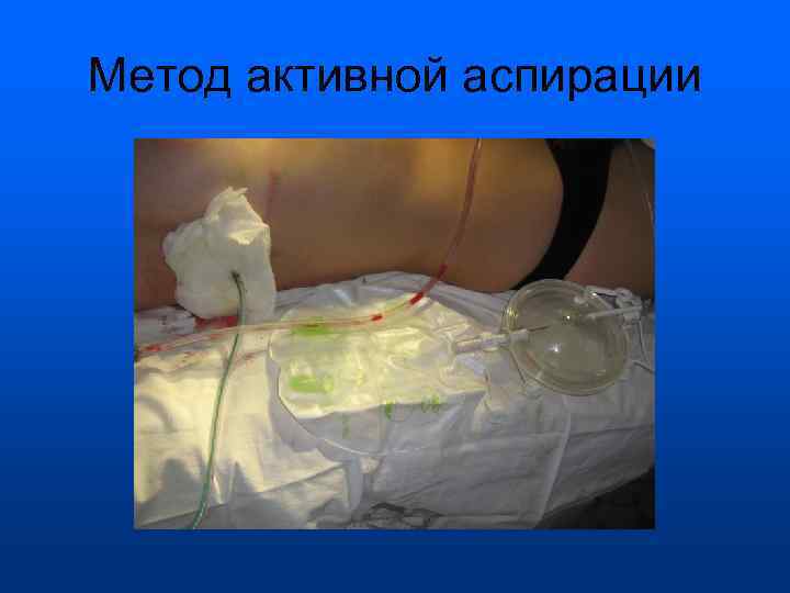 Метод активной аспирации 