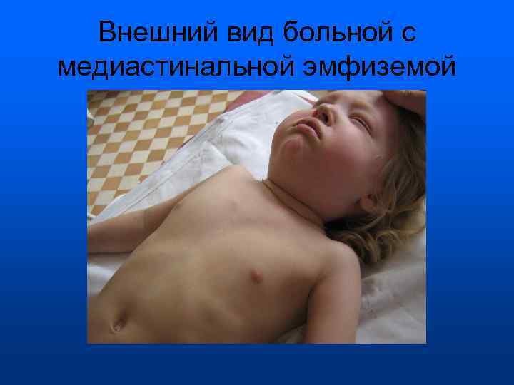  Внешний вид больной с медиастинальной эмфиземой 