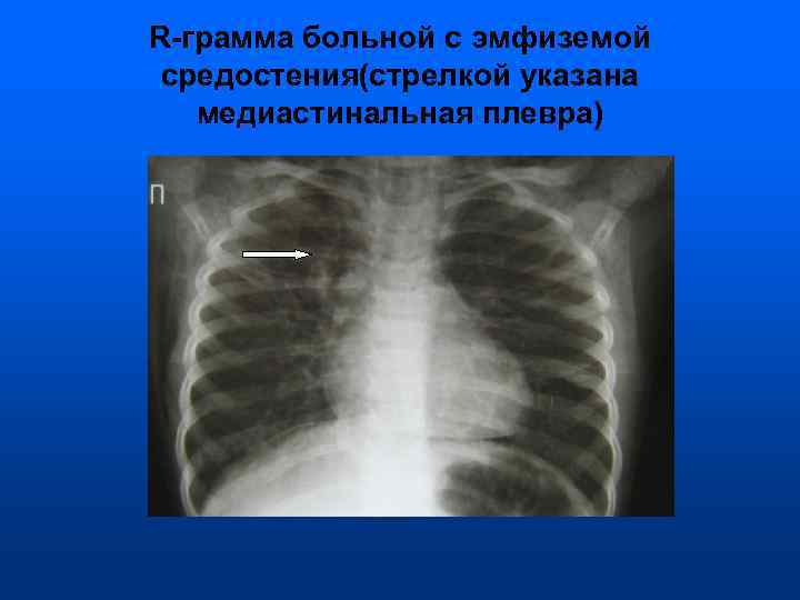 R-грамма больной с эмфиземой средостения(стрелкой указана  медиастинальная плевра) 