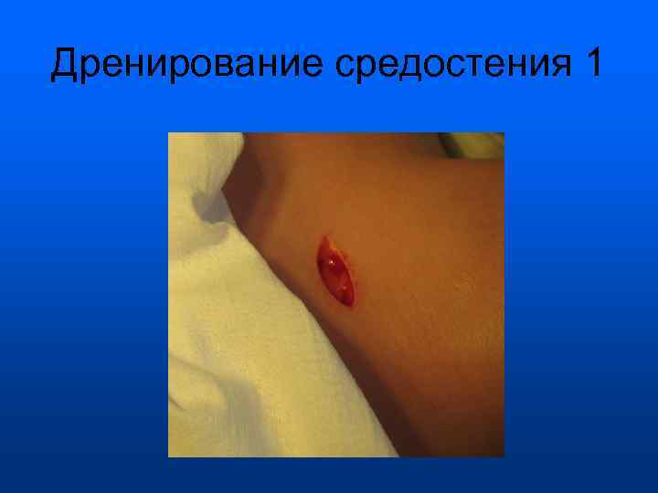 Дренирование средостения 1 