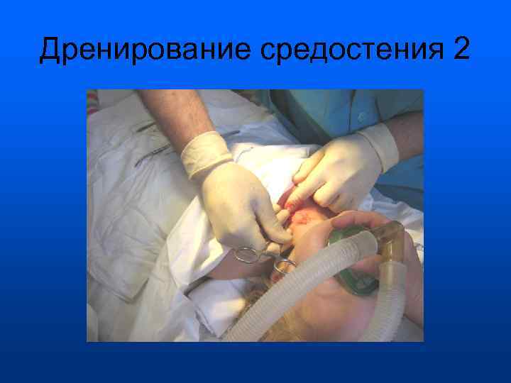 Дренирование средостения 2 