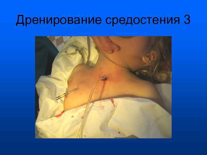Дренирование средостения 3 