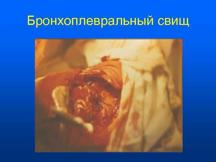 Бронхоплевральный свищ 