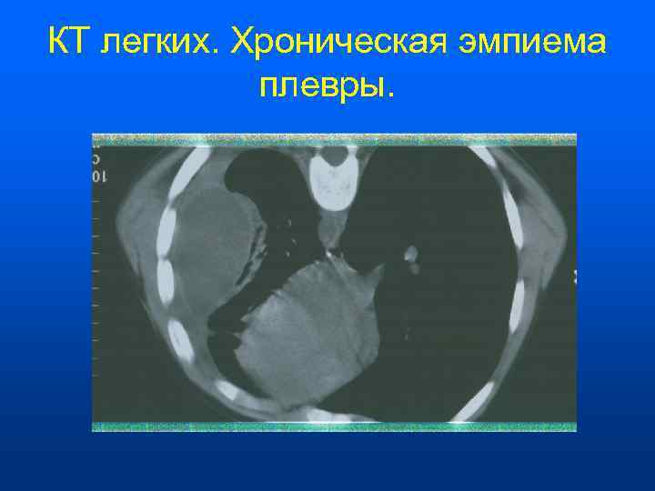 КТ легких. Хроническая эмпиема   плевры. 