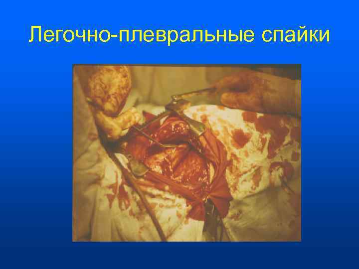 Легочно-плевральные спайки 