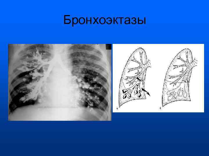 Бронхоэктазы 