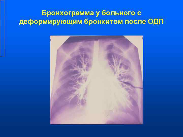  Бронхограмма у больного с деформирующим бронхитом после ОДП 