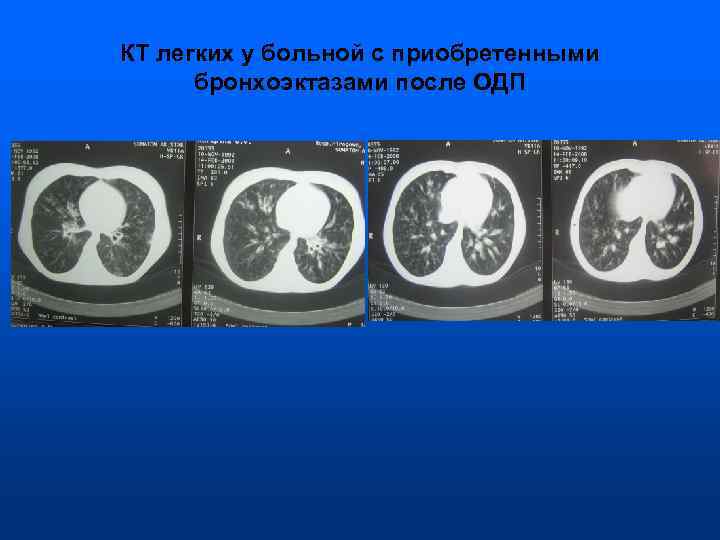 КТ легких у больной с приобретенными  бронхоэктазами после ОДП 