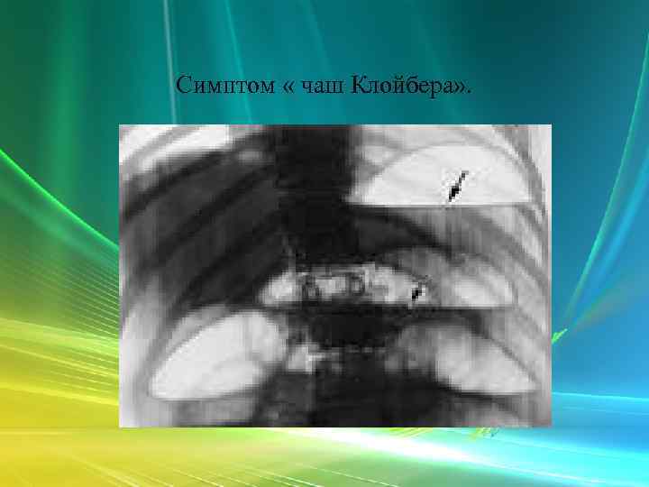 Симптом « чаш Клойбера» . 
