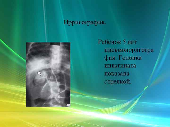 Ирригография.   Ребенок 5 лет   пневмоирригогра   фия. Головка 