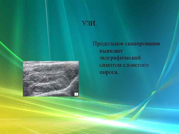 УЗИ. Продольное сканирование выявляет эхографический симптом слоистого пирога. 
