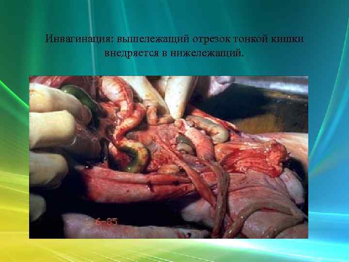 Инвагинация: вышележащий отрезок тонкой кишки  внедряется в нижележащий. 