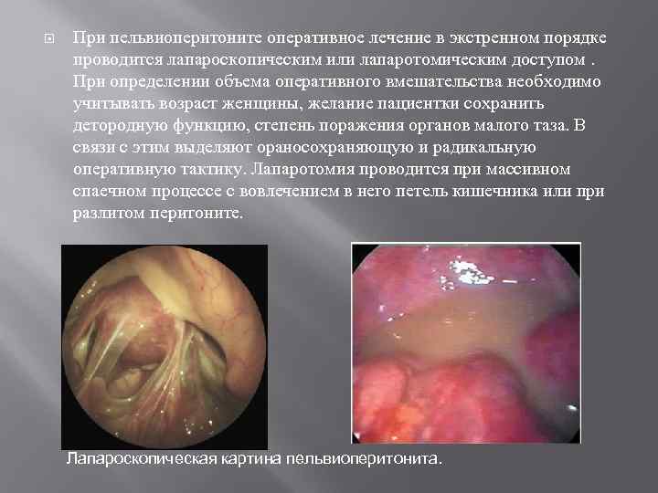   При пельвиоперитоните оперативное лечение в экстренном порядке проводится лапароскопическим или лапаротомическим доступом.