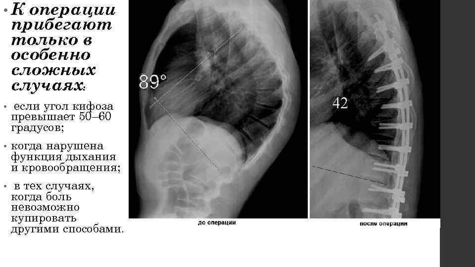  • К  операции прибегают только в особенно сложных случаях:  • если