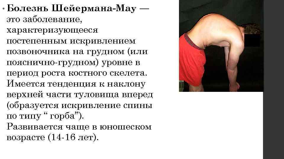  • Болезнь Шейермана-Мау — это заболевание, характеризующееся постепенным искривлением позвоночника на грудном (или