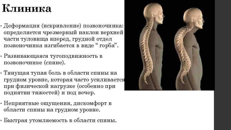 Болезнь шейермана мау что. Болезнь Шейермана МАУ клиника. Кифоз болезнь Шейермана-МАУ. Искривление позвоночника Шерман МАУ. Болезнь Шейермана МАУ 3 степени.