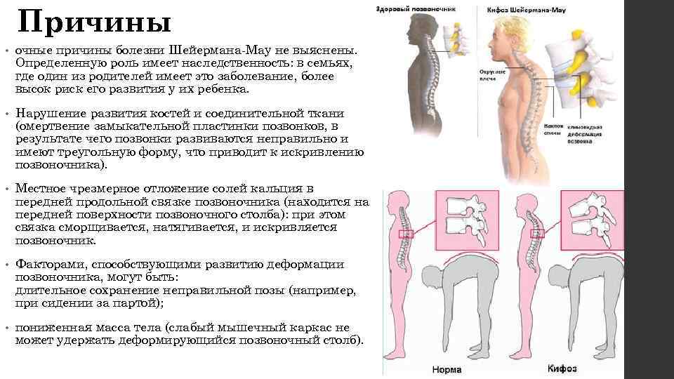   Причины •  очные причины болезни Шейермана-Мау не выяснены. Определенную роль имеет