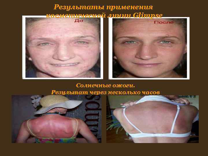Результаты применения косметической линии Glimpse Солнечные ожоги. Результат через несколько Результаты применения косметической линии Glimpse Солнечные ожоги. Результат через несколько