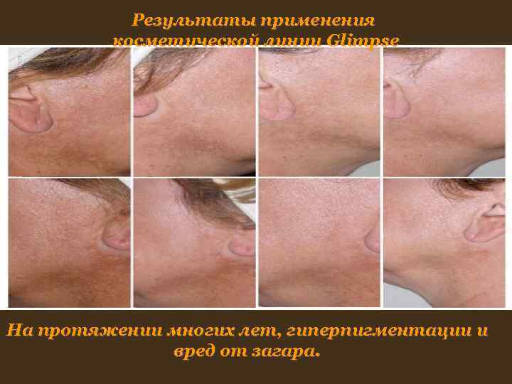Результаты применения косметической линии Glimpse На протяжении многих лет, гиперпигментации и Результаты применения косметической линии Glimpse На протяжении многих лет, гиперпигментации и