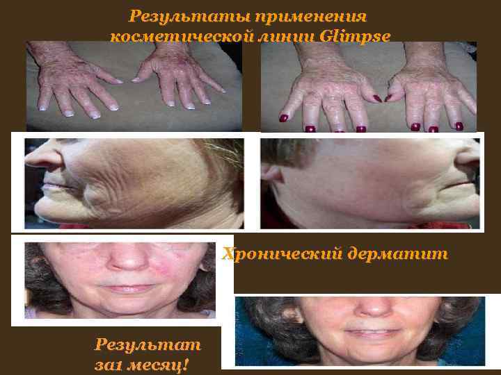 Результаты применения косметической линии Glimpse Хронический дерматит Результат за Результаты применения косметической линии Glimpse Хронический дерматит Результат за
