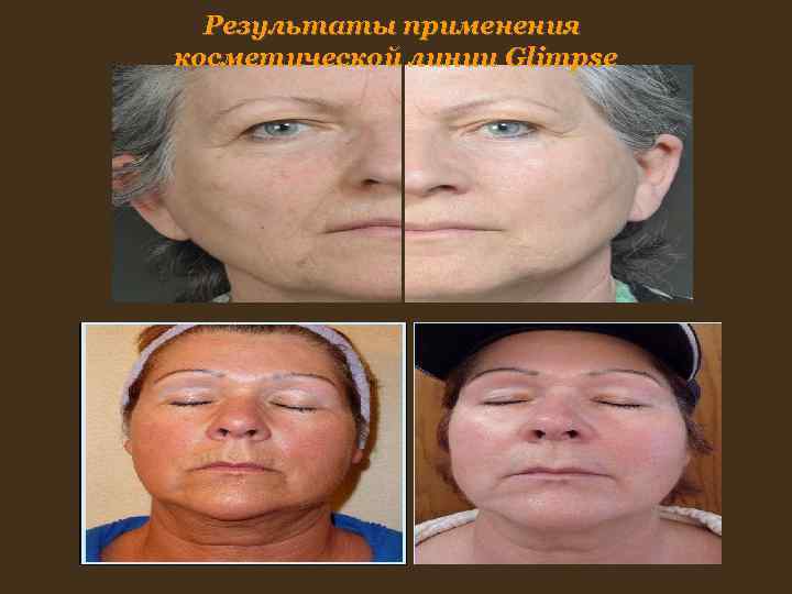 Результаты применения косметической линии Glimpse Результаты применения косметической линии Glimpse
