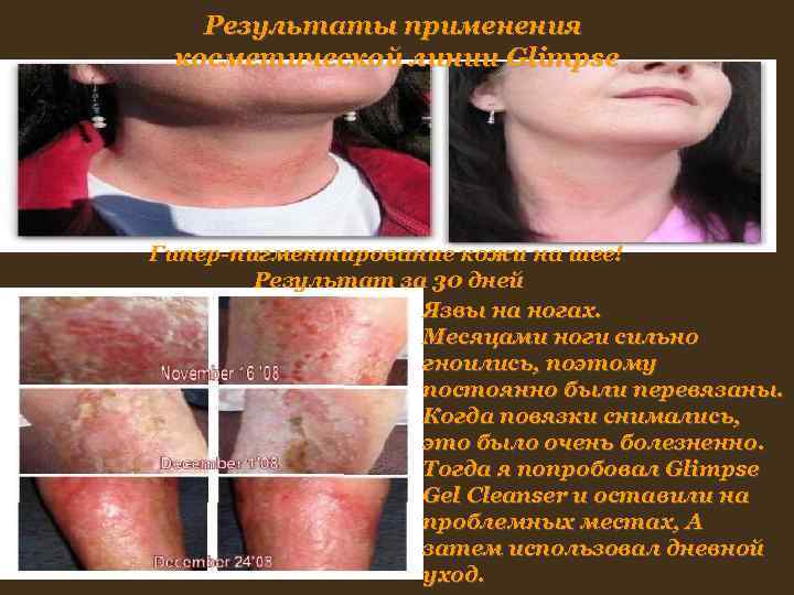 Результаты применения косметической линии Glimpse Гипер-пигментирование кожи на шее! Результаты применения косметической линии Glimpse Гипер-пигментирование кожи на шее!