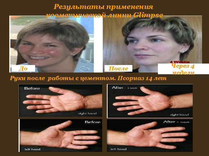 Результаты применения косметической линии Glimpse До После Результаты применения косметической линии Glimpse До После